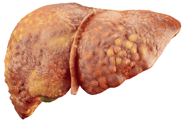 cirrhosis