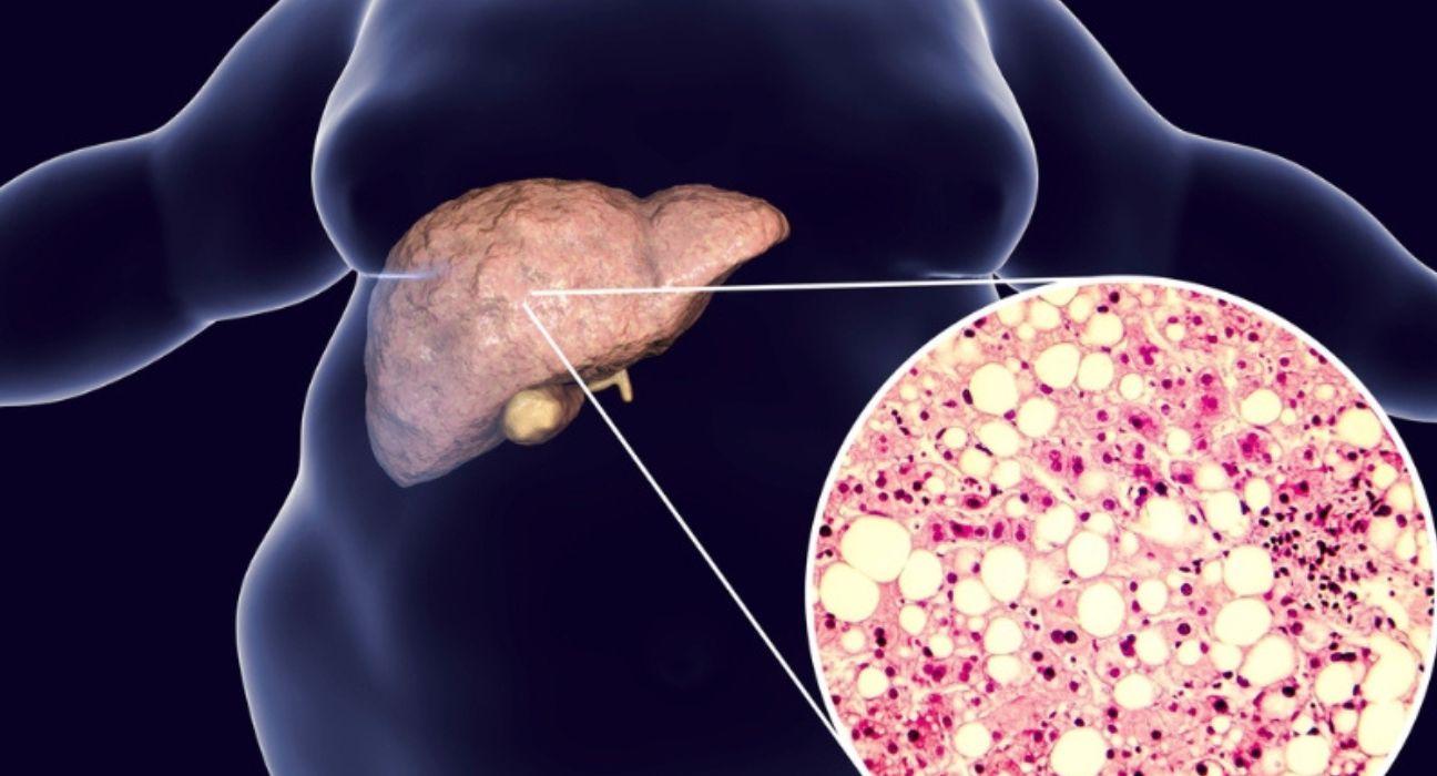 fatty Liver