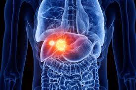 livercancer