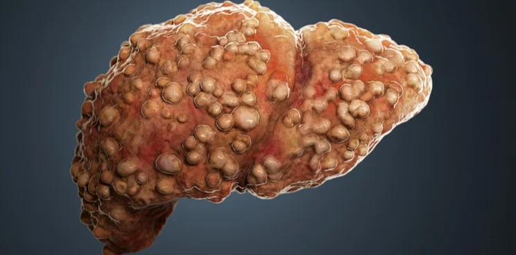liver fibrosis